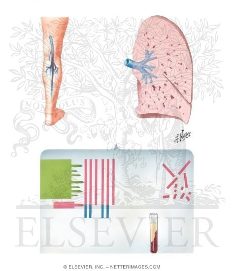 Fibrin Degradation Products (FDP) in Diagnosis of Pulmonary Emboli