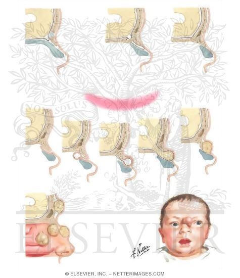 Watermarked preview of unlabeled image: Congenital Nasocranial Malformations