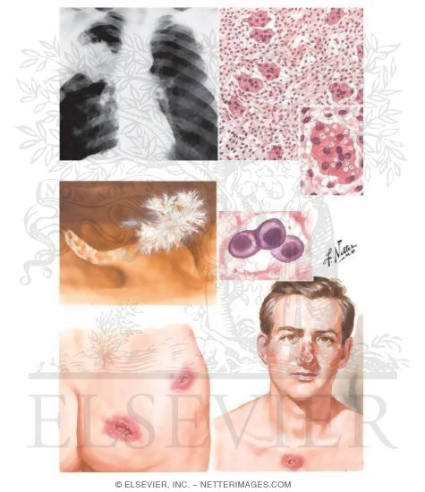 North American Blastomycosis