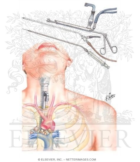 Watermarked preview of unlabeled image: Mediastinoscopy