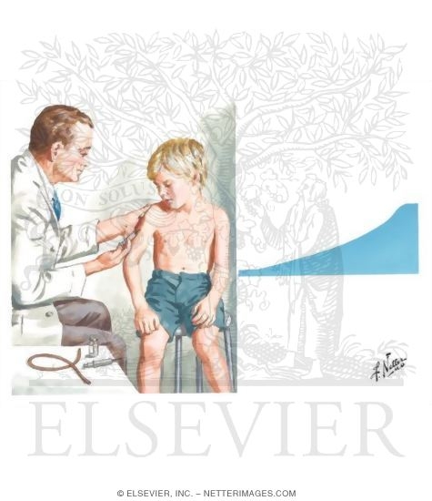 Hyposensitization
