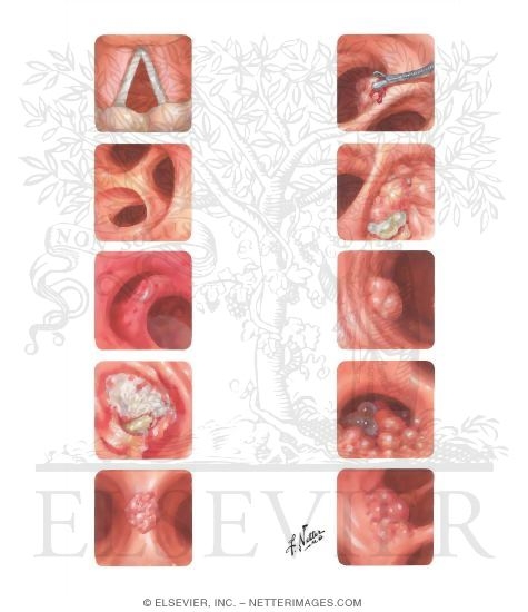 Watermarked preview of unlabeled image: Typical Bronchofiberscopic Views
