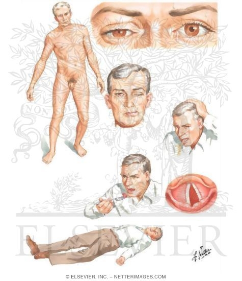 Clinical Manifestations of Vertebrobasilar Territory Ischemia