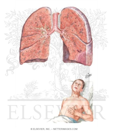 Pulmonary Infarction