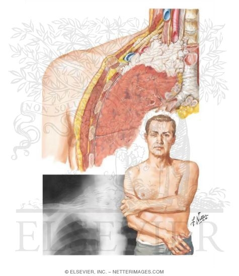 Pancoast's Syndrome