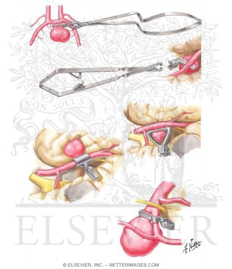 Aneurysm Clips