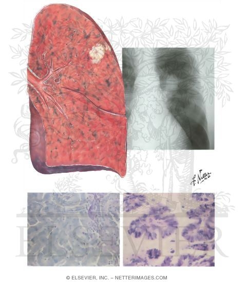Watermarked preview of unlabeled image: Bronchogenic Carcinoma: Adenocarcinoma