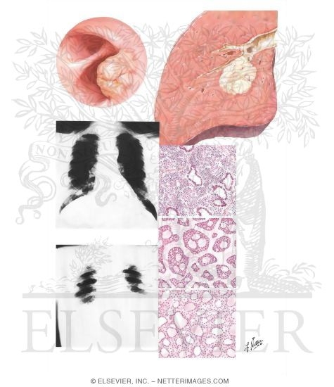 Bronchial Adenoma