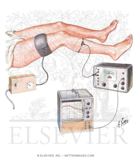 Watermarked preview of unlabeled image: Plethysmography in Diagnosis of Leg Vein Thrombosis