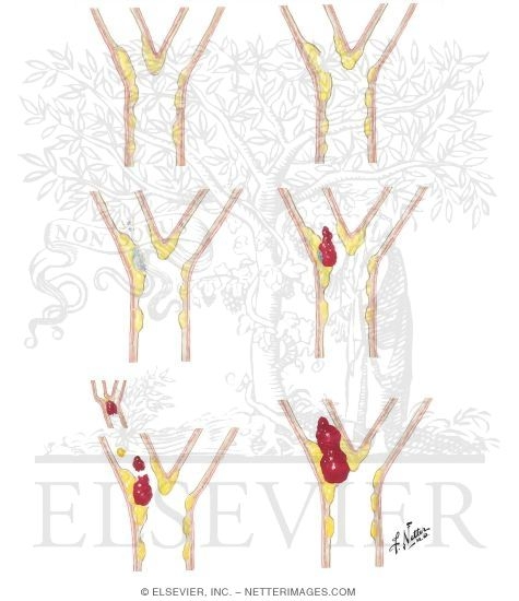 Atherosclerosis, Thrombosis, and Embolism