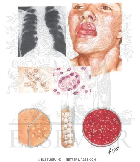 South American Blastomycosis
