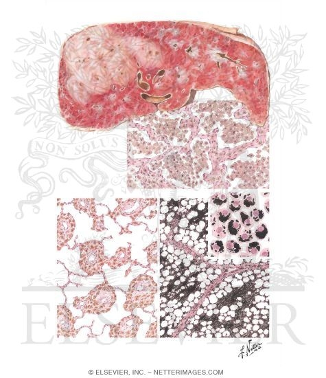Other Mineral Pneumoconioses