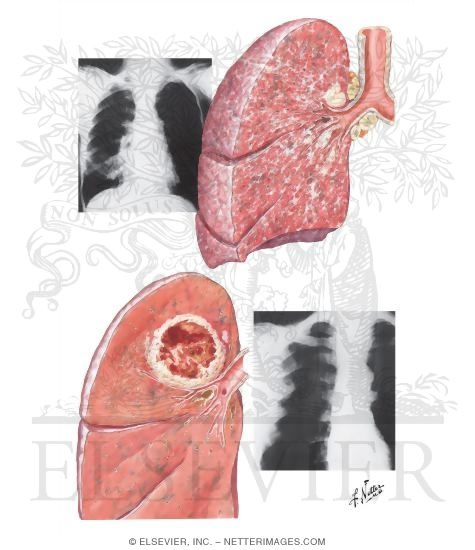 Watermarked preview of unlabeled image: Lymphangitic Spread of Cancer in Lung