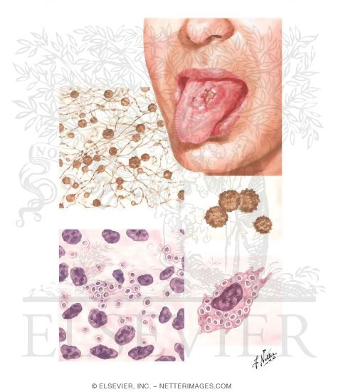 Histoplasmosis