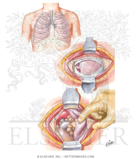 Mediastinotomy