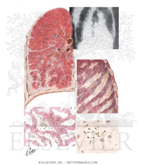 Asbestosis