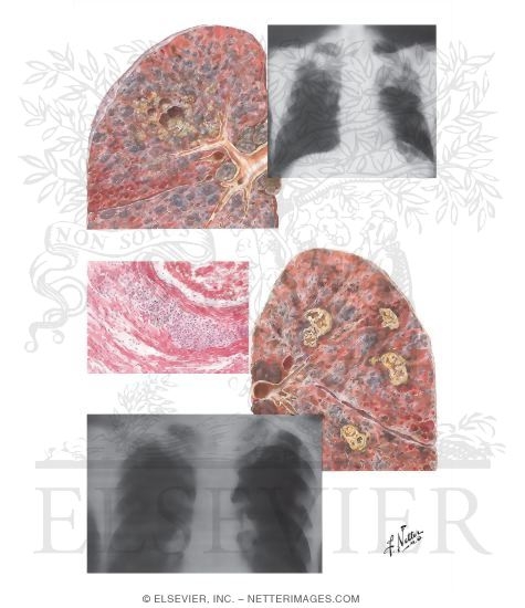 Watermarked preview of unlabeled image: Silicotuberculosis