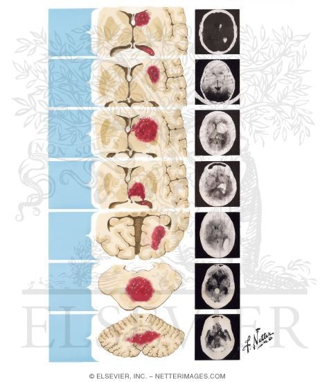 Watermarked preview of unlabeled image: Intracerebral Hemorrhage: Clinical Manifestations Related to Site