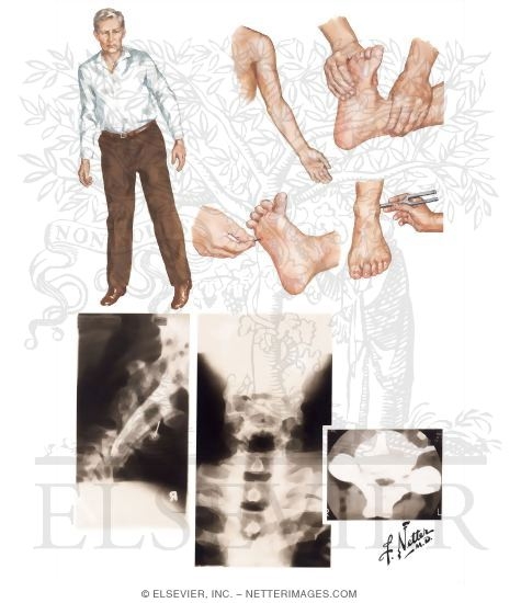 Watermarked preview of unlabeled image: Cervical Spondylosis