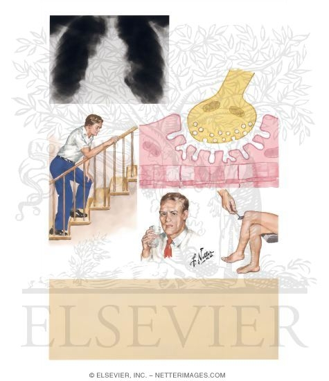 Lambert-Eaton Syndrome