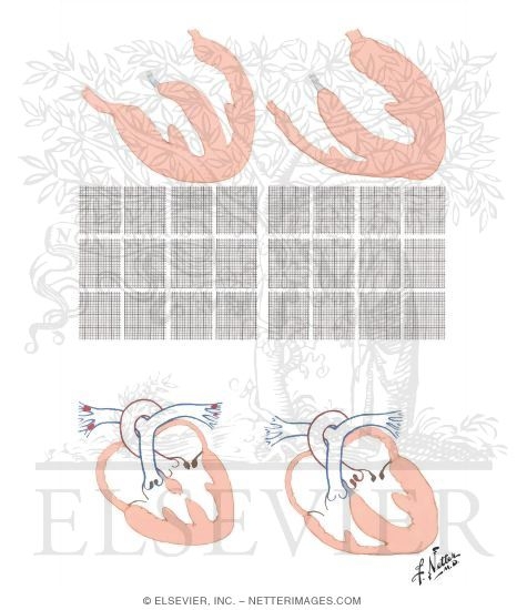 Right Ventricular Hypertrophy and Left Ventricluar Hypertrophy