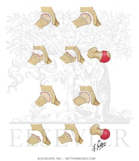 Catterall and Salter-Thompson Classifications