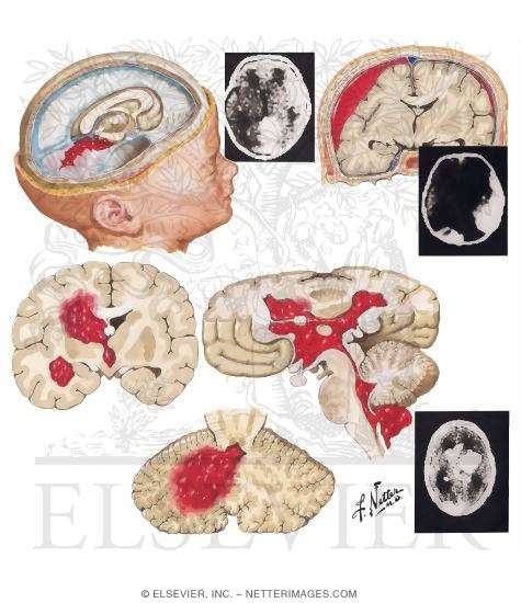 Watermarked preview of unlabeled image: Intracranial Hemorrhage in Newborn