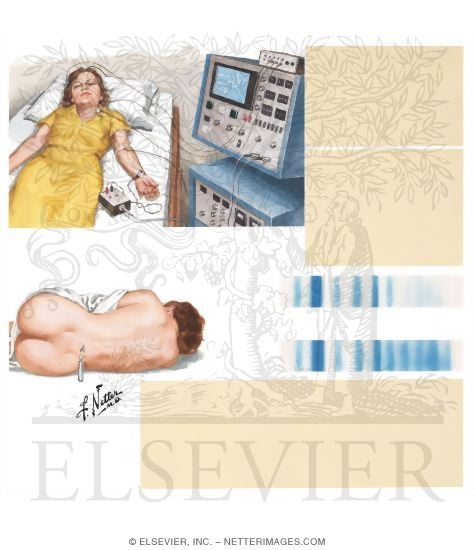Watermarked preview of unlabeled image: Multiple Sclerosis: Diagnostic Tests
