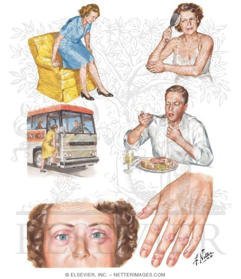 Polymyositis and Dermatomyositis
