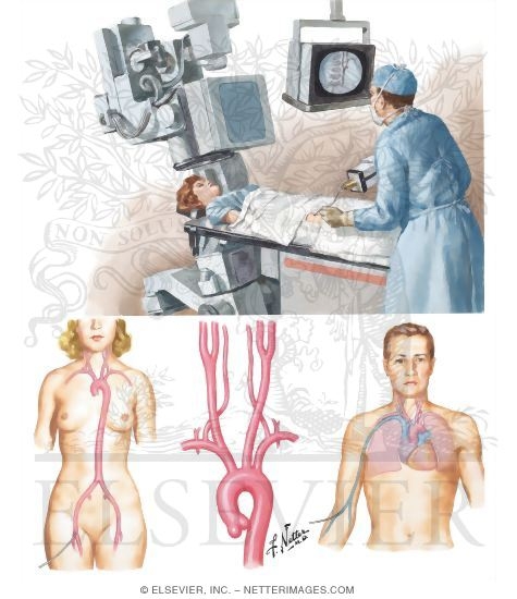 Watermarked preview of unlabeled image: Angiography of Cervical and Cerebral Vessels