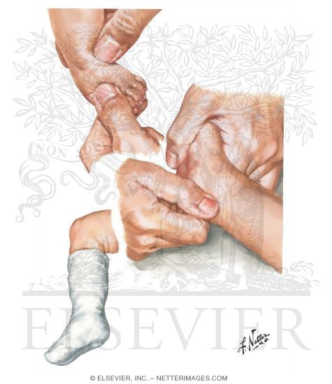 Watermarked preview of unlabeled image: Corrective Manipulation for Congenital Clubfoot