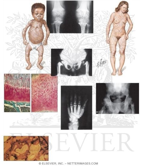 Childhood Rickets, Adult Osteomalacia