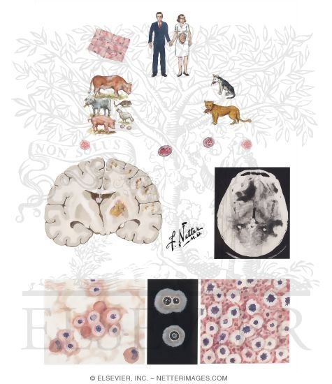 Watermarked preview of unlabeled image: Toxoplasmosis