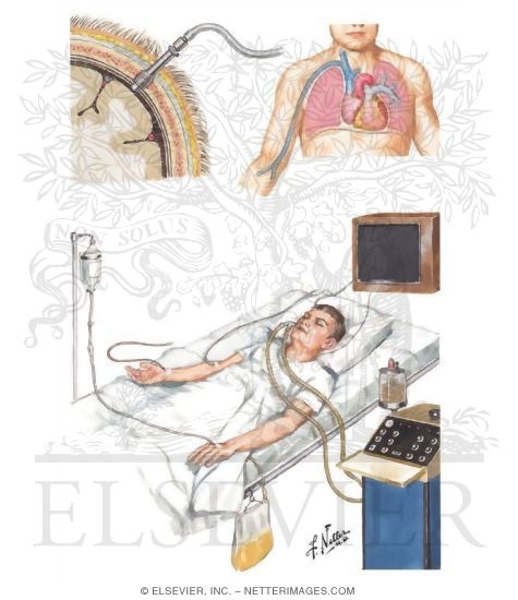Watermarked preview of unlabeled image: Intensive Medical Management of Severe Head Injury