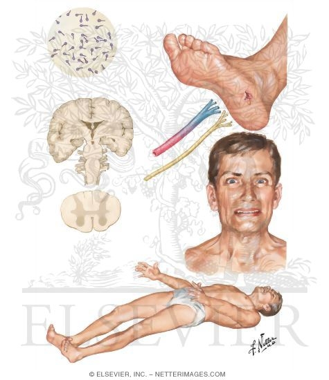 Tetanus