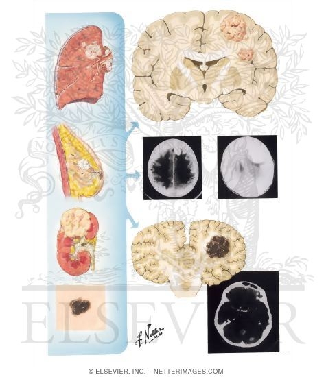 Tumors Metastatic to Brain