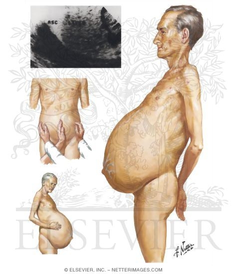 Ascites 