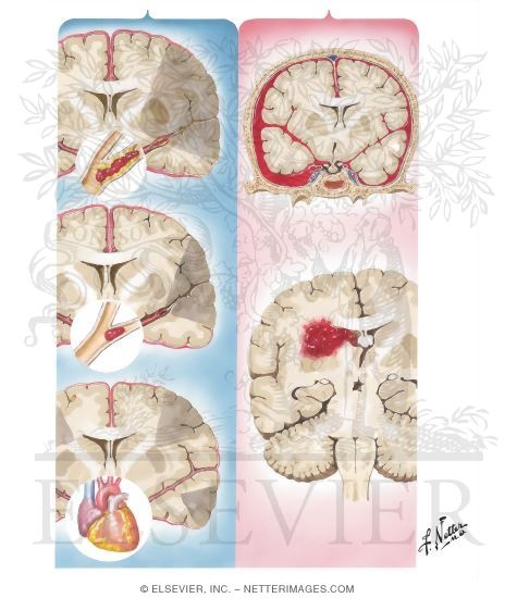 Diagnosis of Stroke