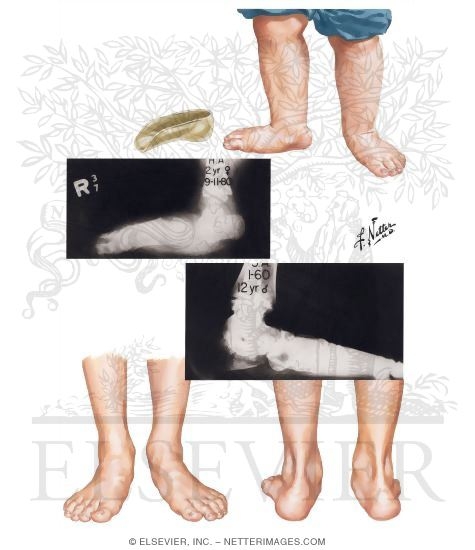Calcaneovalgus and Planovalgus
