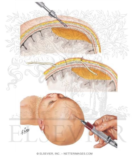 Craniostomy for Chronic Subdural Hematoma
