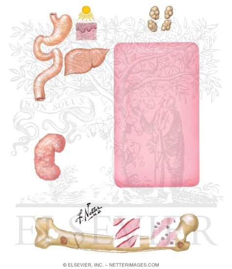 Watermarked preview of unlabeled image: Metabolic Aberrations of Renal Osteodystrophy