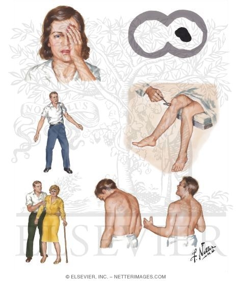 Watermarked preview of unlabeled image: Multiple Sclerosis: Clinical Manifestations