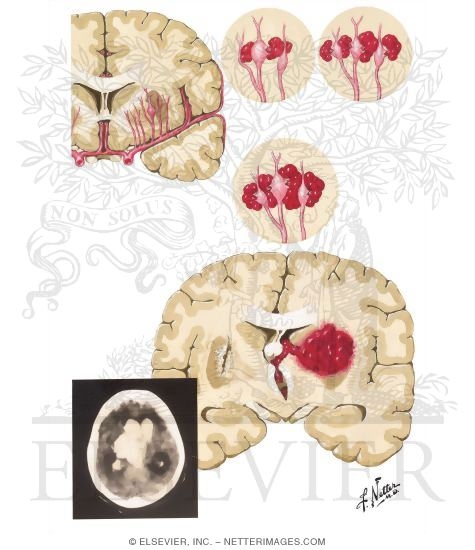 Intracerebral Hemorrhage (Hypertensive): Pathogenesis
