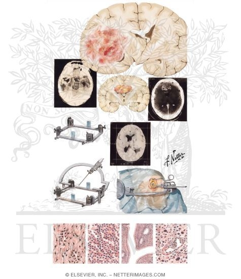 Watermarked preview of unlabeled image: Gliomas