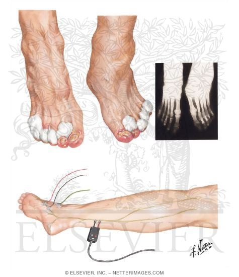 Hereditary Sensory Neuropathy
