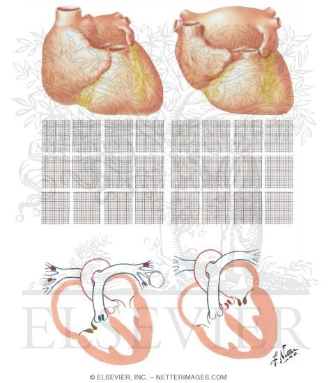 Watermarked preview of unlabeled image: Atrial Enlargements