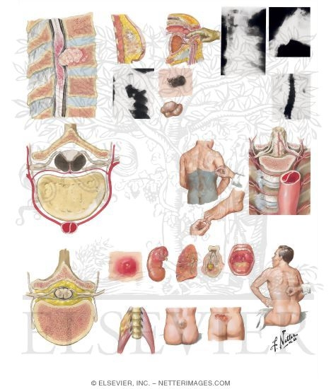 Watermarked preview of unlabeled image: Acute Spinal Cord Syndromes: Pathology, Etiology and Diagnosis