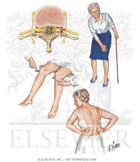 Diabetic Radiculopathy