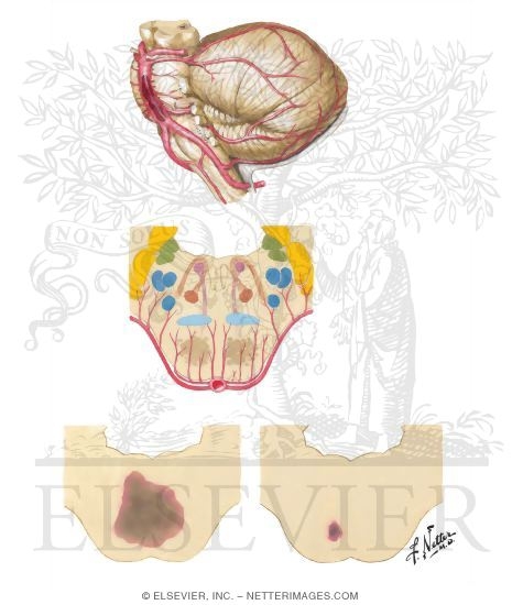 Occlusion of Basilar Artery and Branches