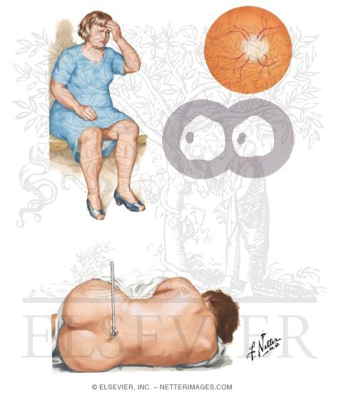 Pseudotumor Cerebri